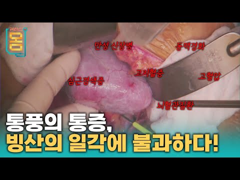 [Full] 통풍의 통증, 빙산의 일각에 불과하다!ㅣ귀하신 몸ㅣ54화 통풍이 무서운 진짜 이유