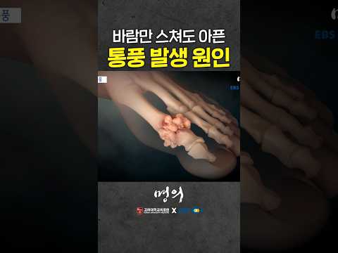 2030 환자 급증! 통풍 발생 원인