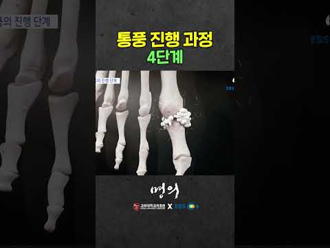 무시무시한 통풍 진행과정 4단계