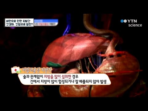 비만으로 인한 지방간, 간경화*간암으로 발전? / YTN 사이언스