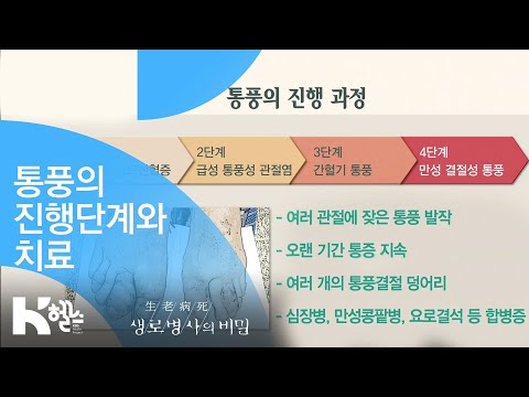 통풍의 진행단계와 치료 - (20181031_668회 방송) 내가 키운 고통, 통풍의 오해와 진실