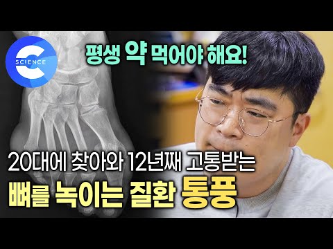 뼈를 녹이는 질환 '통풍'이 진짜 무서운 이유는? | 통풍 4기로 고통받는 30대 | 통풍의 원인과 치료법 | 통풍 부르는 식습관