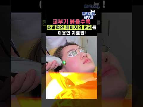 안면홍조 레이저 치료_ 브이빔 프리마를 이용한 홍반유도 프리마! #shorts