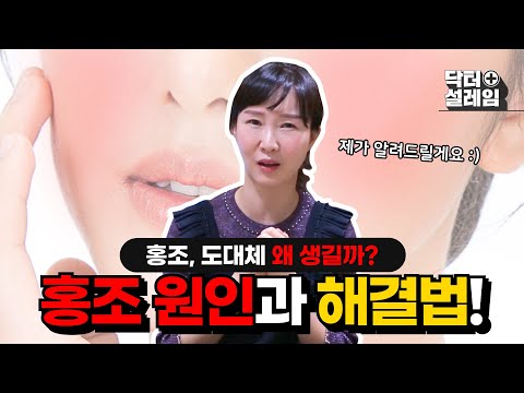 안면홍조, 드디어 제가 잡았습니다! 직접 효과보고 말씀드리는 시술! (엑셀브이레이저, 실펌레이저)