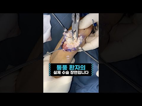 통풍 실제 수술 장면입니다. 비위가 약한 분은 패스해 주세요